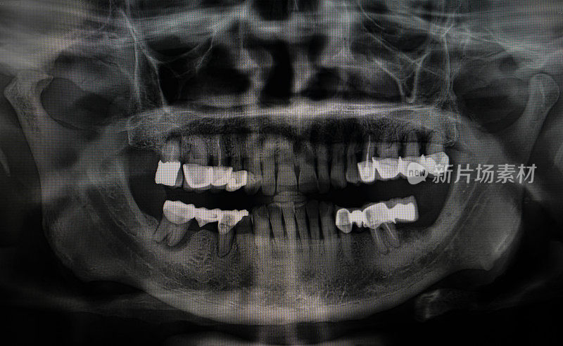 一位老人的牙科x光片。