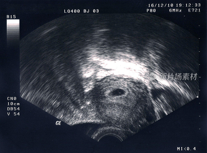 胎儿超声检查，5周