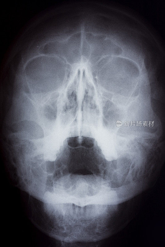 人类头骨的x光图像