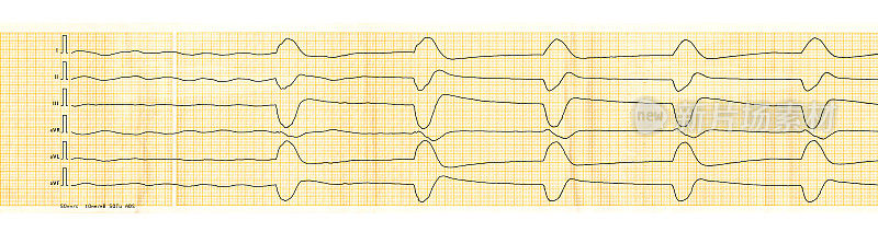 心电图带伴慢心室节律