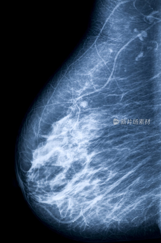 乳房及乳头x线影像