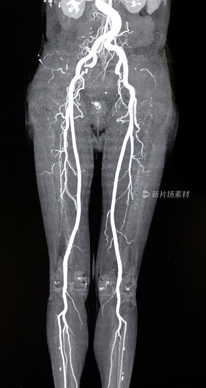 下肢动脉MRA