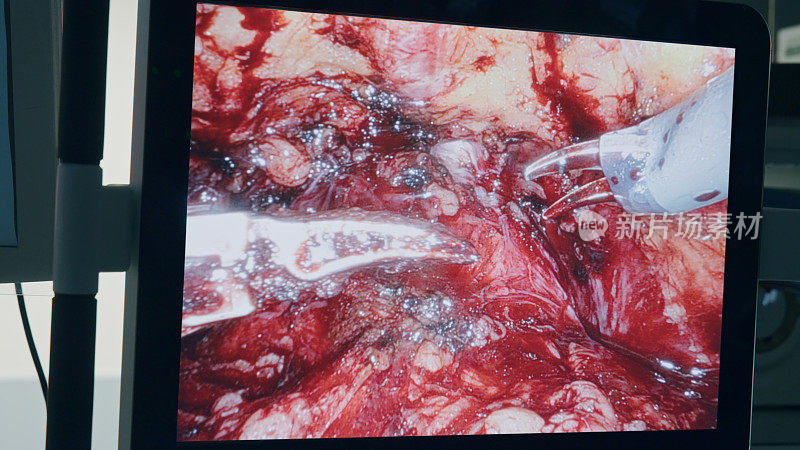 医疗机器人。腹腔镜腔内手术监视器的特写镜头，腹腔