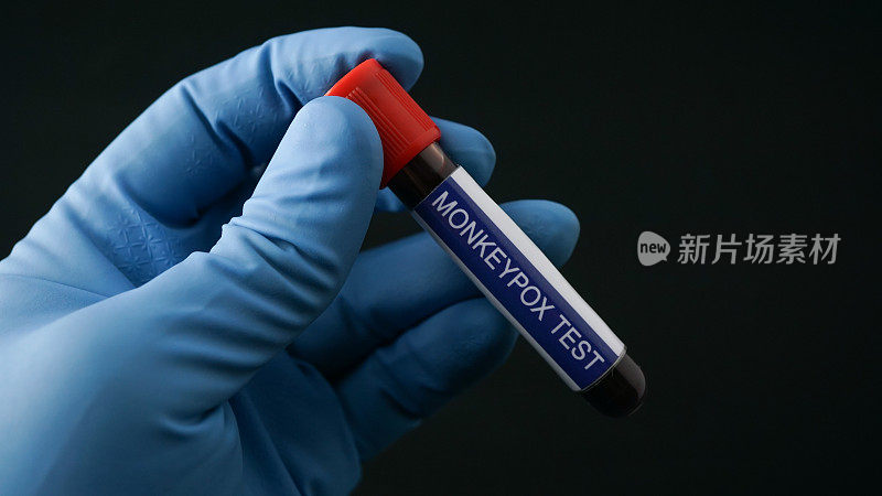 蓝手套猴痘病毒检测血样管。它也被称为Moneypox病毒，是一种双链DNA。
