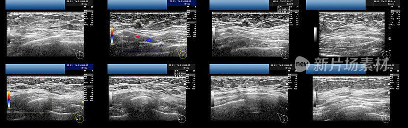右侧乳房和腋窝(腋窝)超声序列
