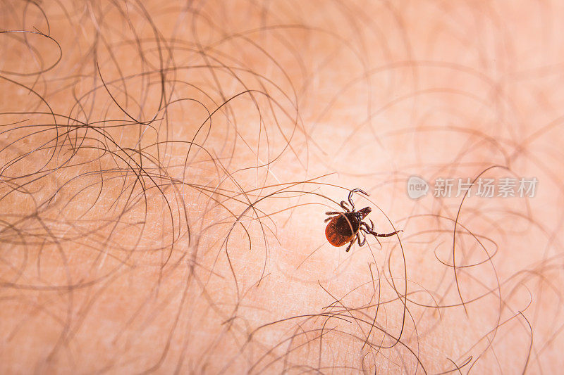 寄生在人类皮肤上的蜱