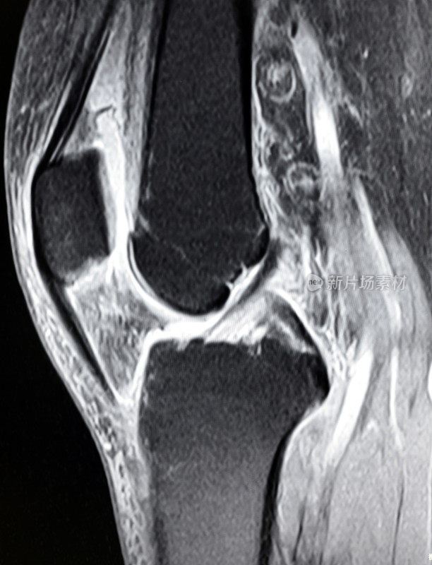 膝关节MRI图像