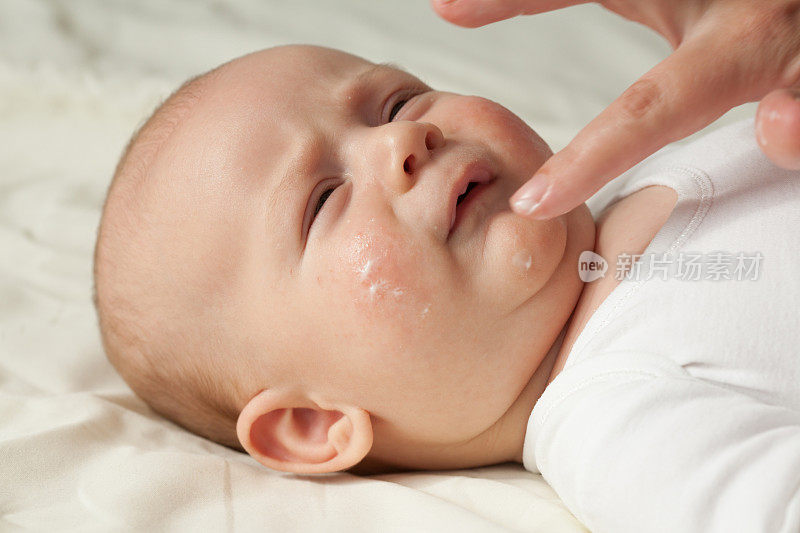 患有特应性皮炎的宝宝正在涂护肤霜