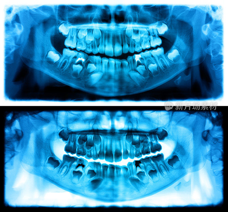 蓝色全景x光片是一种上下颌全景扫描牙科x光片。这是焦平面断层扫描显示的是一个七岁小孩的上颌骨和下颌骨。