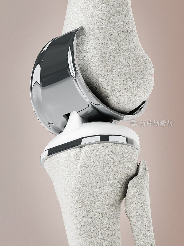 膝关节置换与植入的3D插图