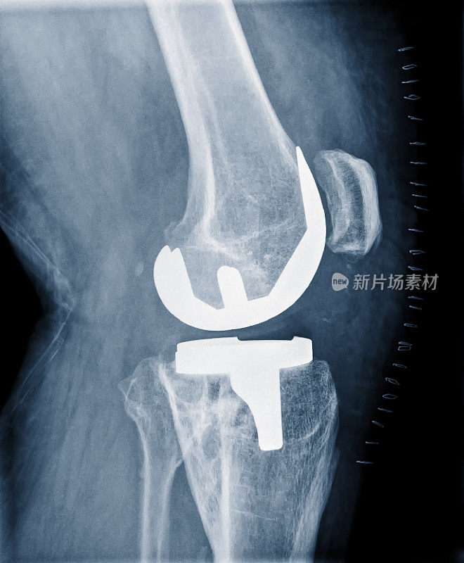 膝关节置换术成功后的x光片