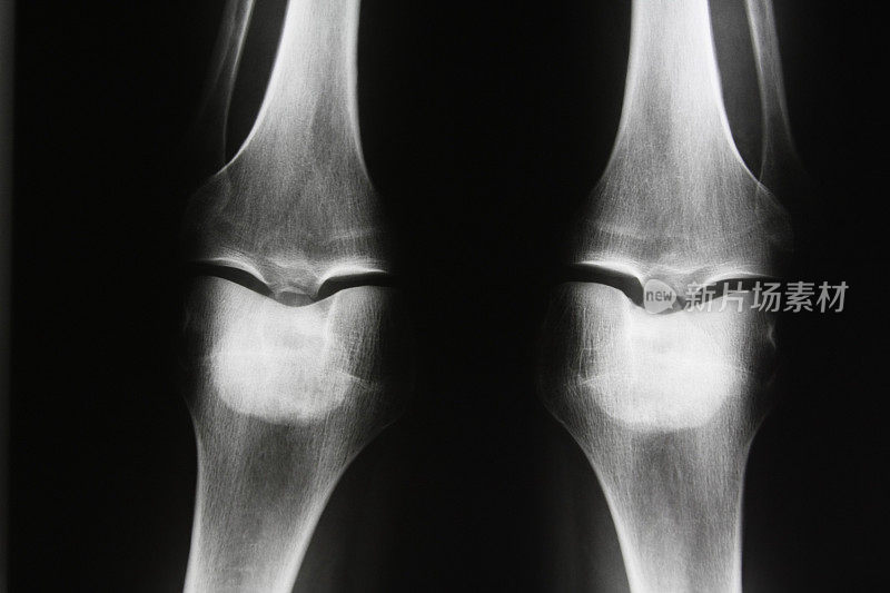 人类膝盖的x光图像…有关节炎的人