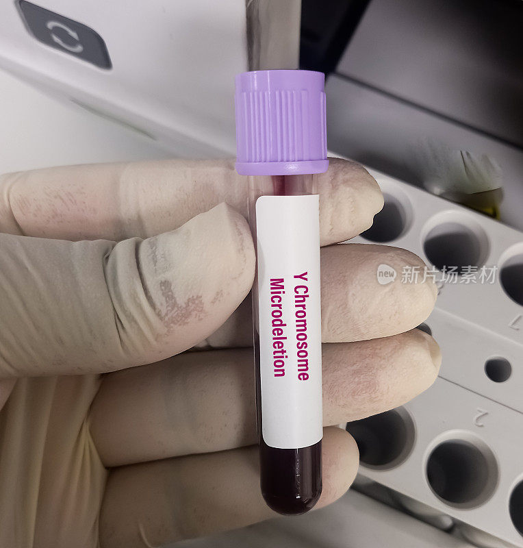 血液样本进行Y染色体微缺失检测以鉴别Y染色体缺失基因。