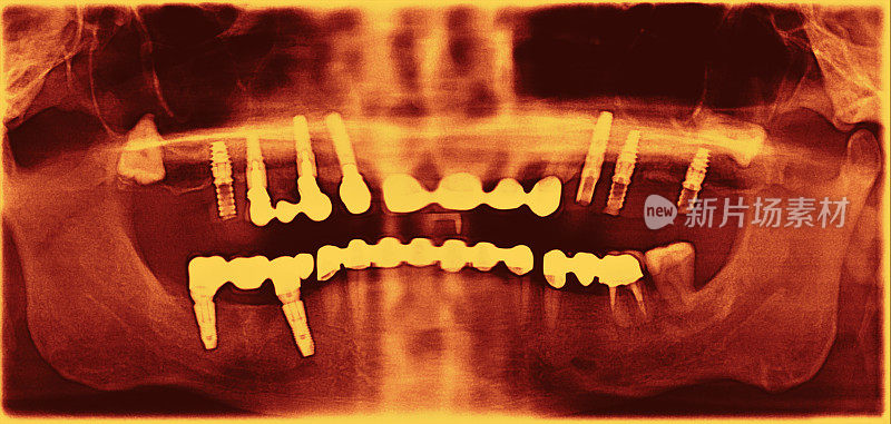 牙科x光检查含种植体的牙齿