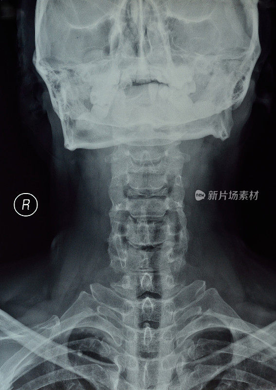 颈椎x线照片