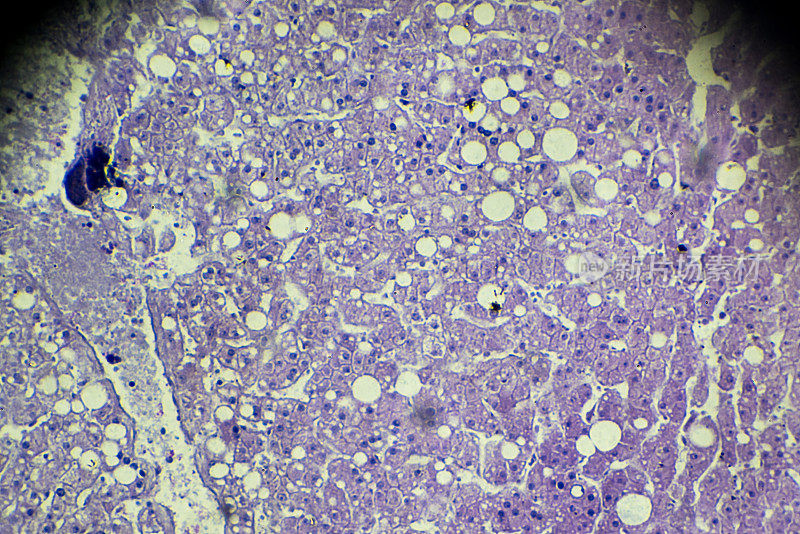 显微镜下肝脏脂肪变性