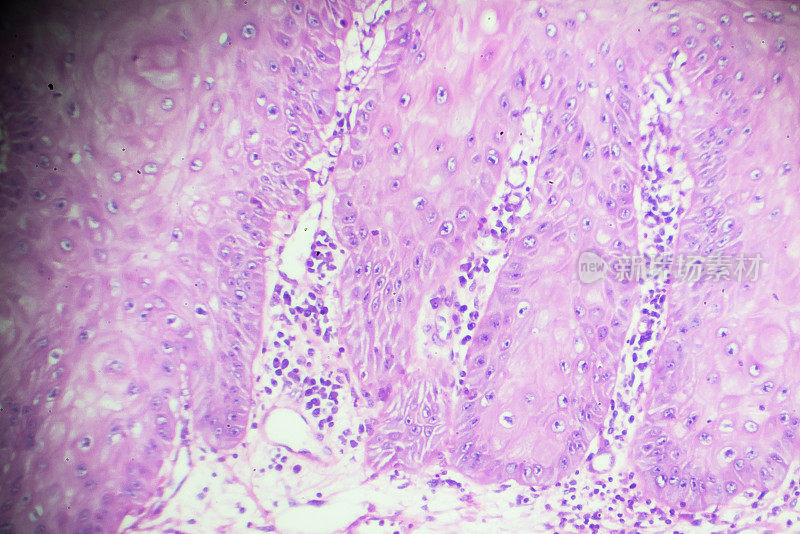 鳞状细胞癌显微镜下