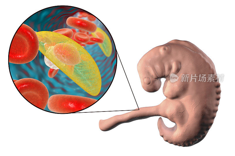 刚地弓形虫寄生虫传播给胎儿的医学概念
