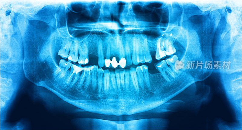 蓝色全景x光片是一种上下颌全景扫描牙科x光片。这是焦平面断层扫描显示的上颌骨和一个37岁的男人。