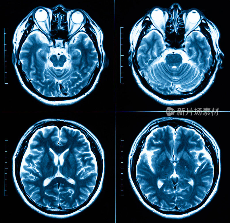 MRI扫描人类头部断层扫描