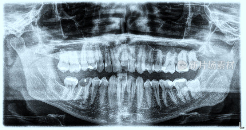 x射线图像,牙齿