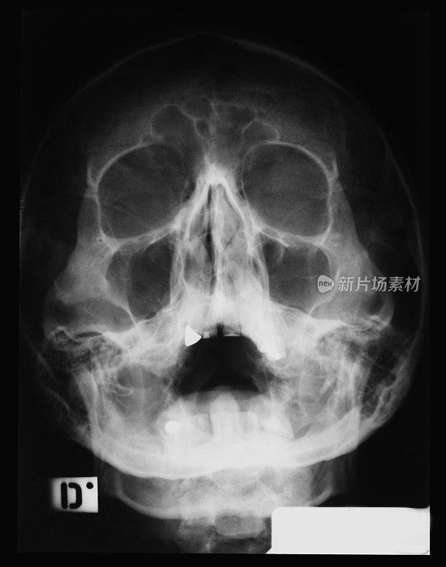 人类头骨的x光图像…可见鼻窦炎