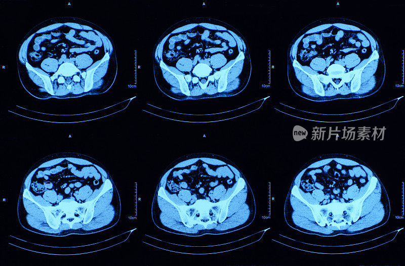 腹腔断层扫描