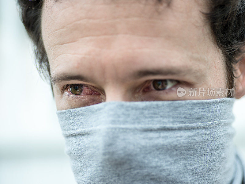 2019冠状病毒病患者红眼和面罩结膜炎