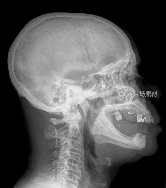 颅骨和颈部x光片