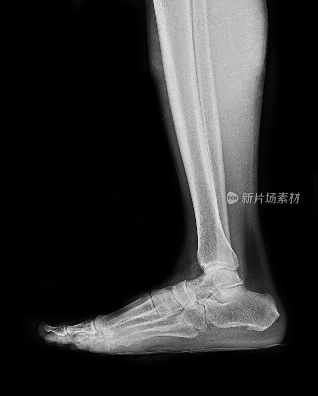 足部骨折患者的x线照片