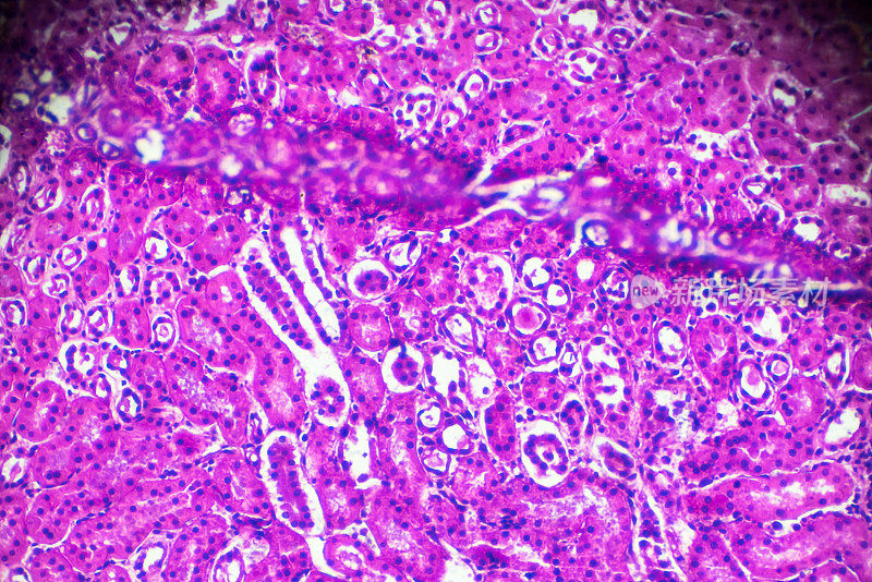 显微镜下急性肾盂肾炎活检标本