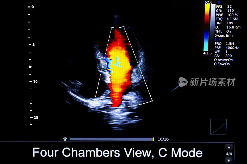 彩色人体心脏超声监测仪图像