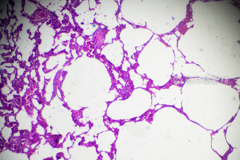 光镜下肺气肿病理