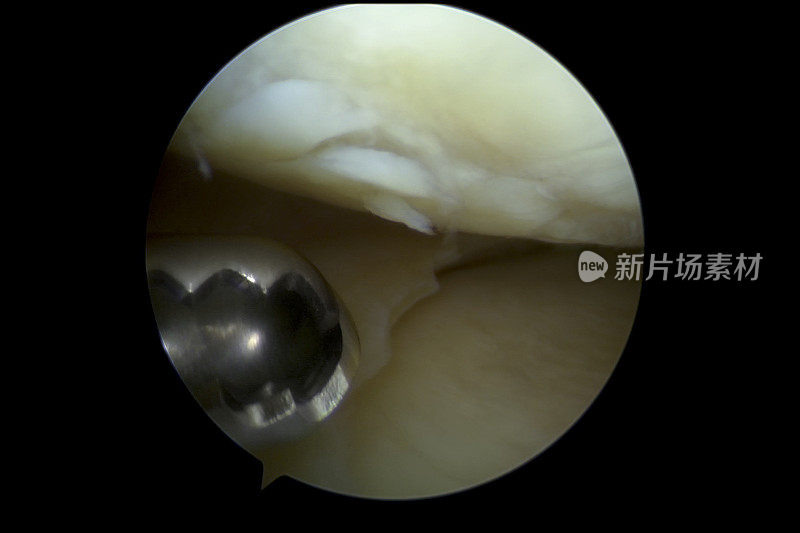 关节镜下的人左膝内侧室关节软骨和半月板的病变