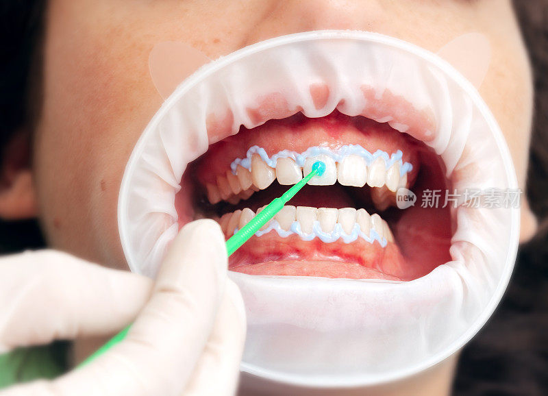 牙齿美白过程的特写。卫生员给病人涂双氧水