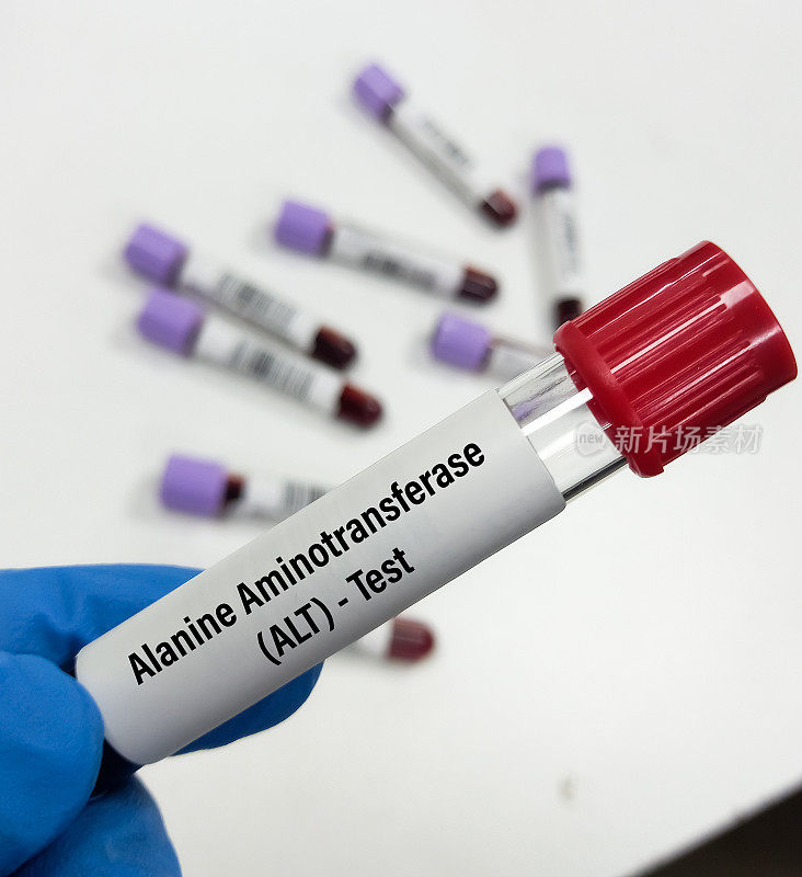 血液样本进行谷丙转氨酶(ALT)或SGPT测试，肝功能测试。ALT血检。