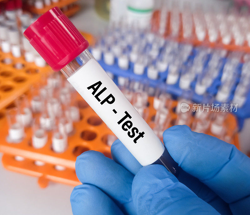 血液ALP(碱性磷酸酶)测试诊断肝脏或骨骼疾病。肝功能检查。