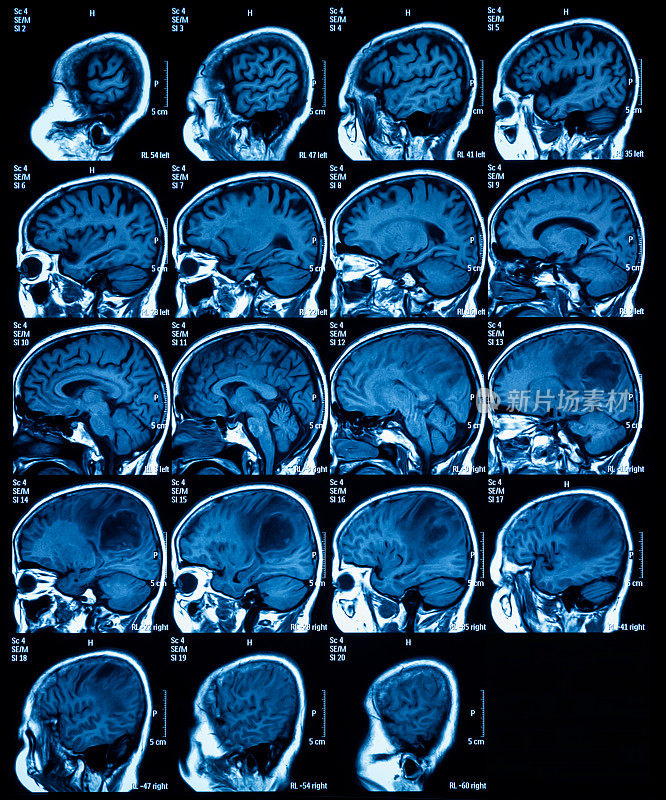 脑磁共振成像(MRI)，脑瘤