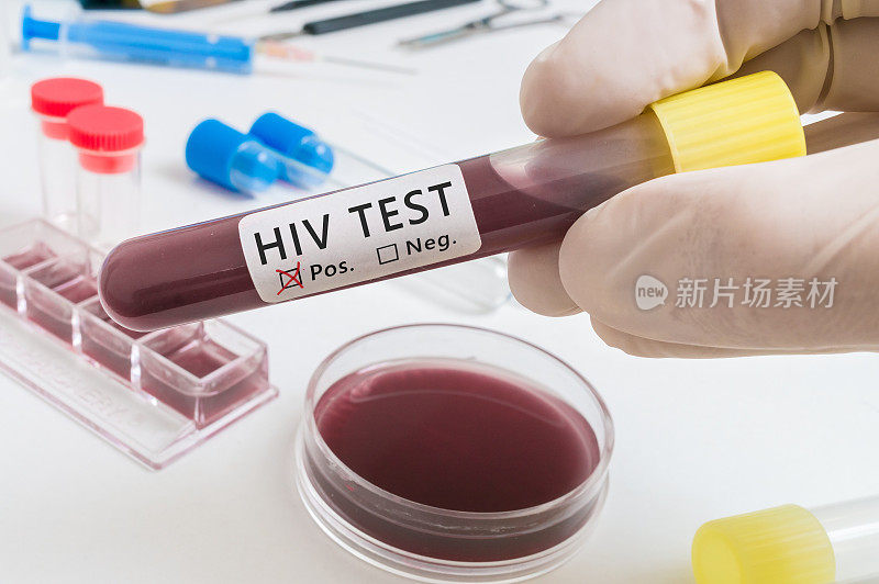 用于分析HIV病毒的血液试管。