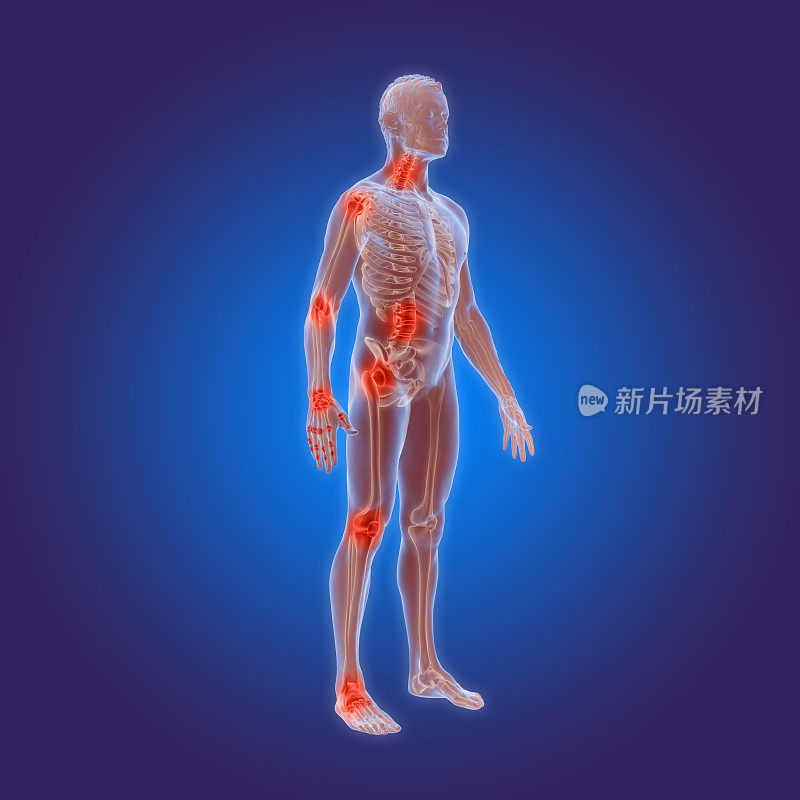 骨关节炎的3D渲染-类风湿性关节炎在人体