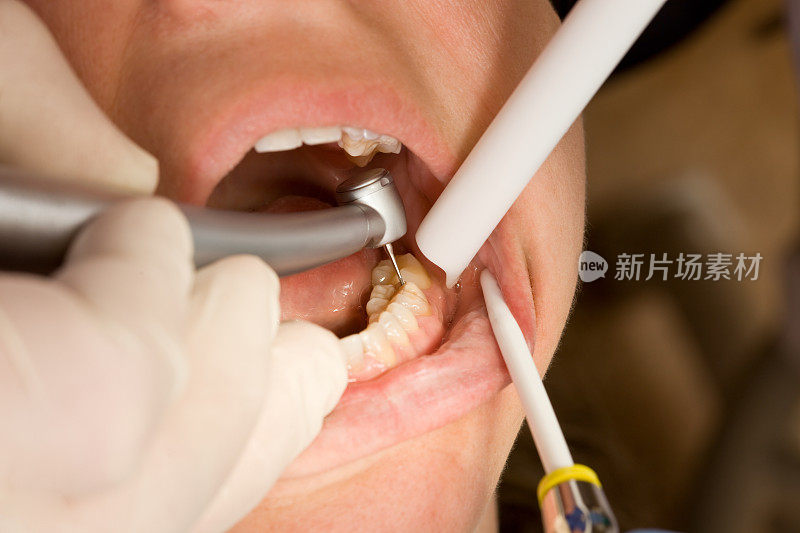 牙医钻牙洞，准备补牙