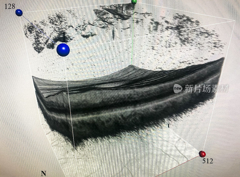 左眼玻璃体滑脱的视盘相干断层扫描三维可视化