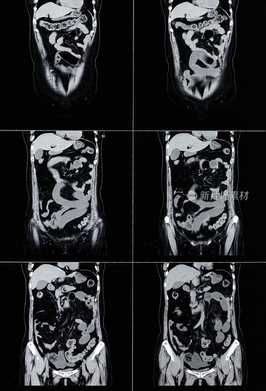 MRI扫描人体腹部正面断层扫描