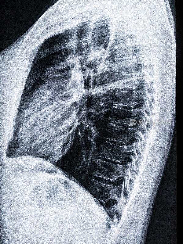 人体肺部x射线扫描