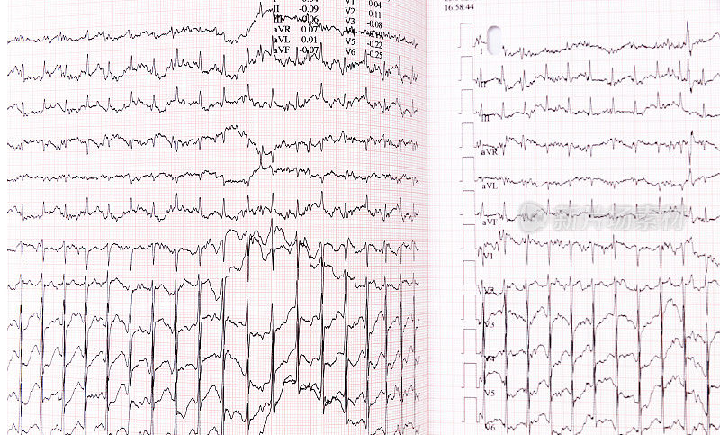 图表心电图(ECG)