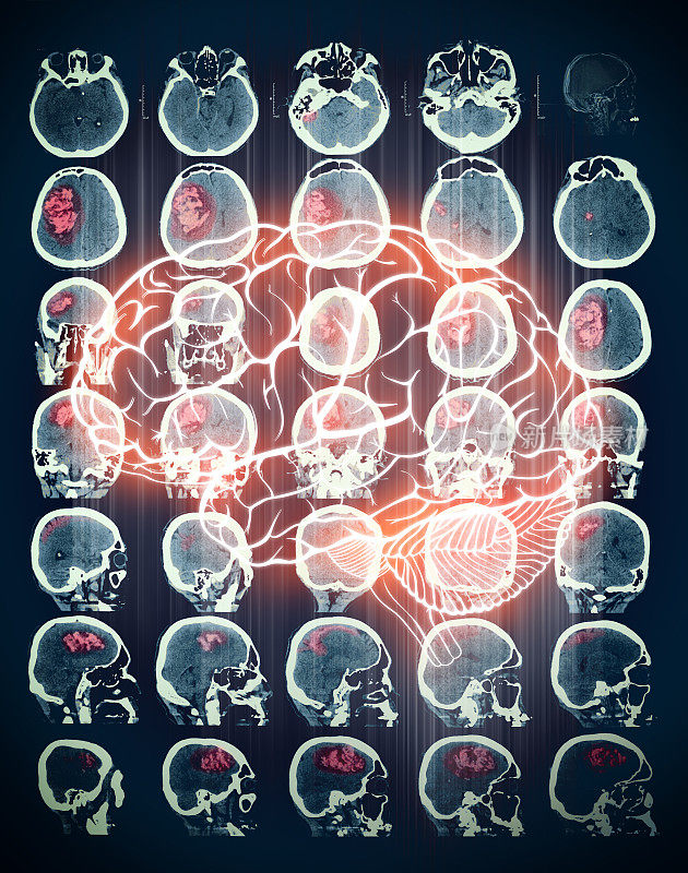 人脑CT扫描上的红色区域