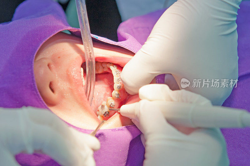 牙科医生用超声波仪器清洁牙齿