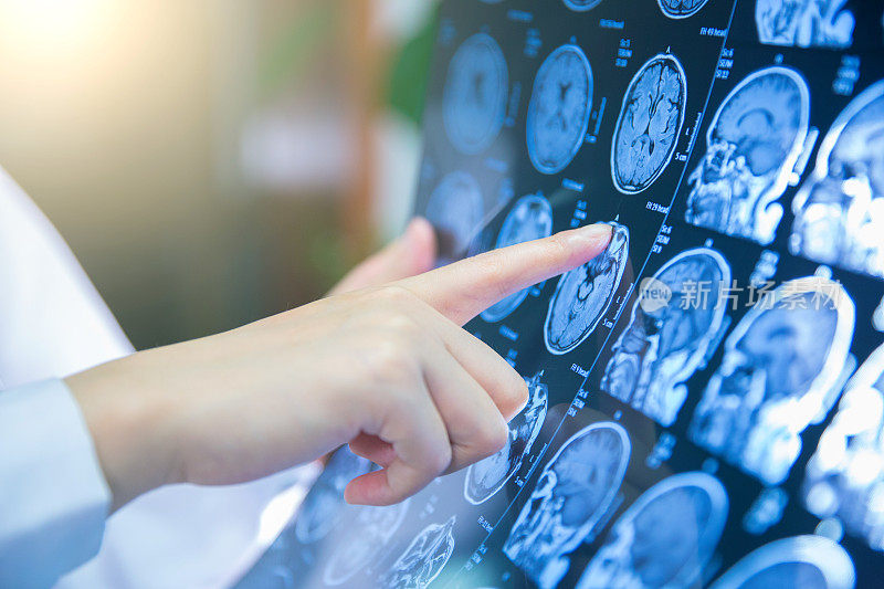 医生用手检查大脑的磁共振成像(MRI)