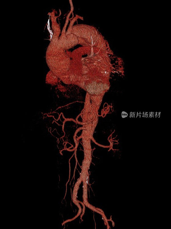 心脏和主动脉的三维计算机断层重建