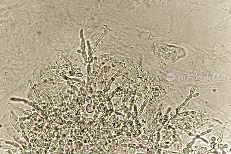 尿中的假菌丝和芽殖酵母细胞